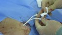 Medcomp Split stream catheter insertion
